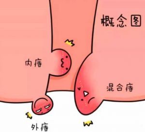 【四院|科普】：痔瘡術(shù)后疼痛的原因及處理