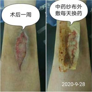 【四院|科普】：脛骨磕了下留下個(gè)小口怎么也好不了，上海一女子趕來(lái)四院求醫(yī)