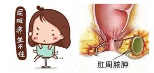 【四院|科普】：肛門旁邊長(zhǎng)了個(gè)包怎么辦？讓我們帶您認(rèn)識(shí)肛周膿腫