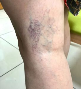 【四院|科普】腿上爬滿的“紅血絲”原來一招就可以解決