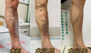全國(guó)下肢靜脈曲張領(lǐng)軍人物梅家才教授 4月湖州行程安排
