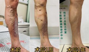 全國(guó)著名靜脈曲張專(zhuān)家 梅家才5月湖州行程