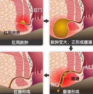 肛瘺不做手術(shù)行嗎？可以自愈嗎？